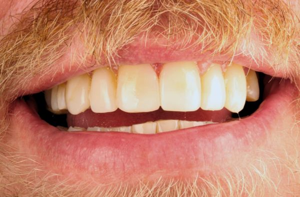 After -Halo Dental