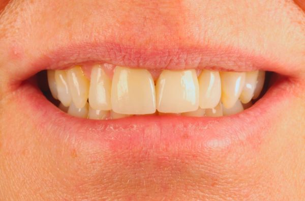 After -Halo Dental