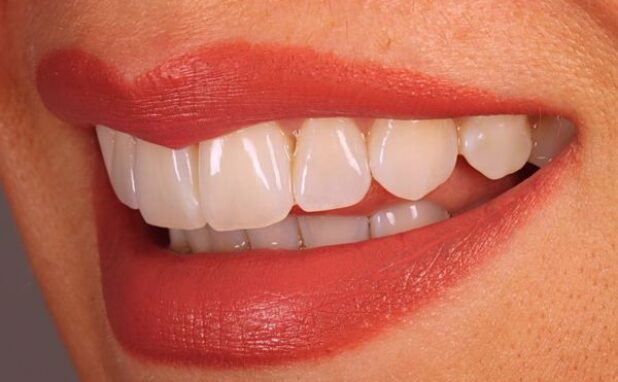 After -Halo Dental