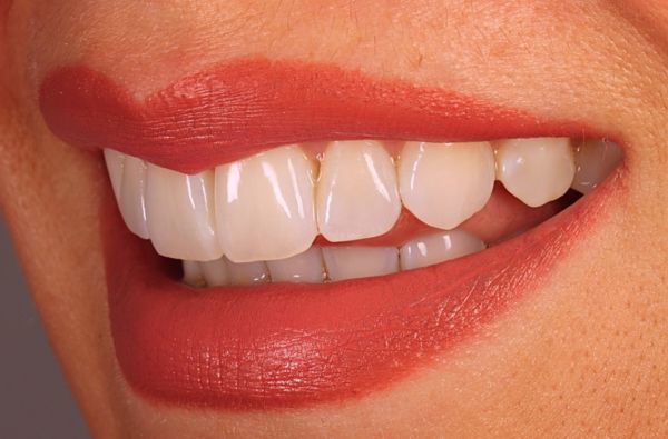 After -Halo Dental