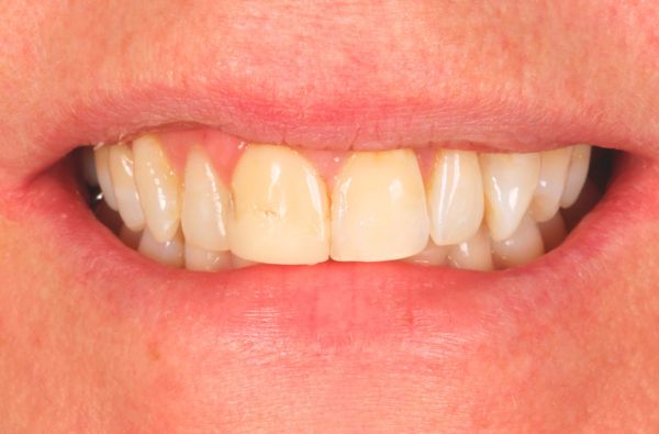 Before - Halo Dental