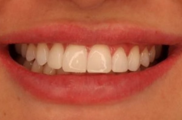 After -Halo Dental