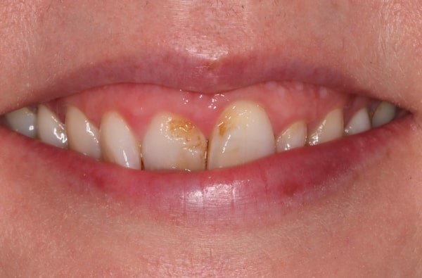 Before - Halo Dental