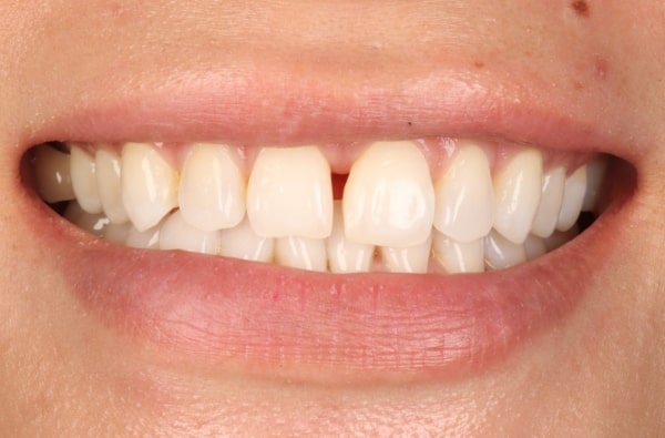 Before - Halo Dental