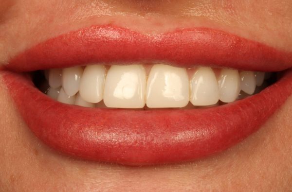 After -Halo Dental