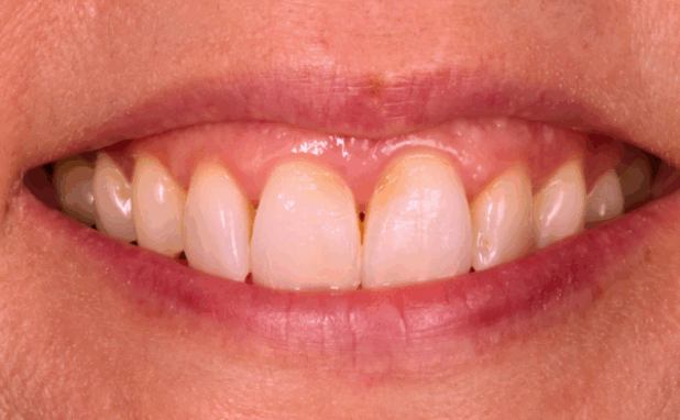 After -Halo Dental