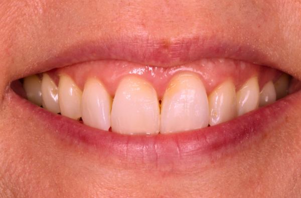After -Halo Dental