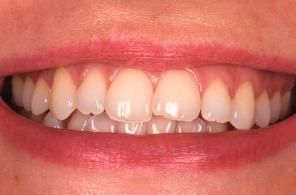Before - Halo Dental