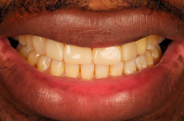 After -Halo Dental