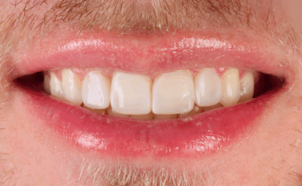 After -Halo Dental