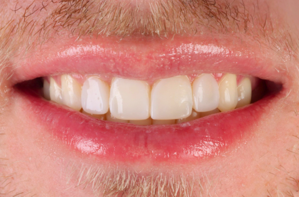 After -Halo Dental