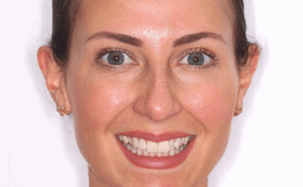 Before - Halo Dental