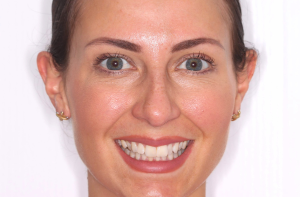 Before - Halo Dental