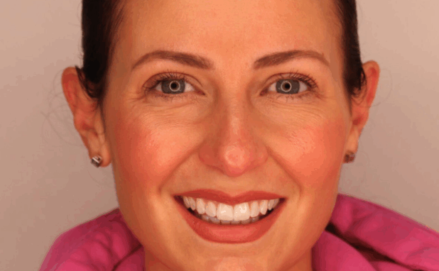 After -Halo Dental