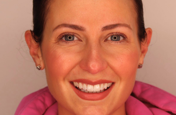 After -Halo Dental