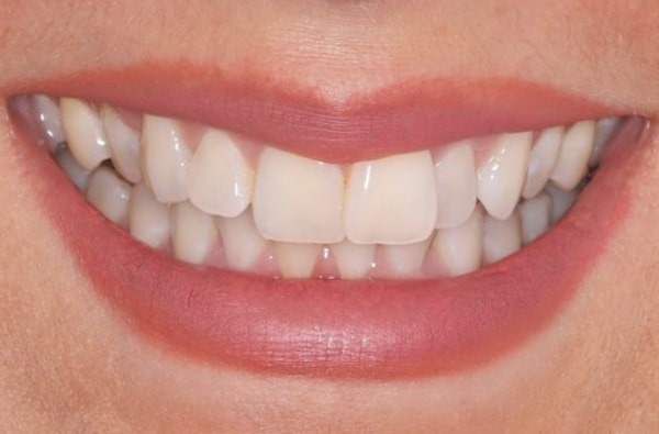 Before - Halo Dental