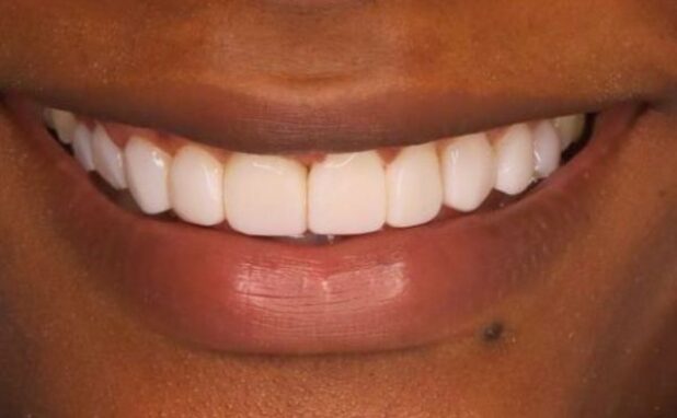 After -Halo Dental