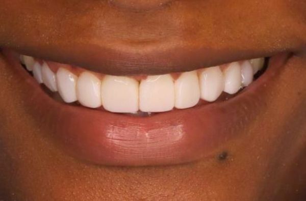 After -Halo Dental