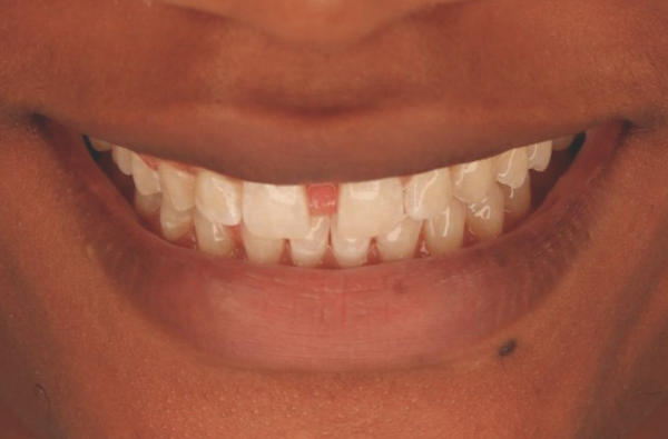 Before - Halo Dental