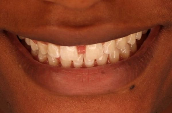 Before - Halo Dental
