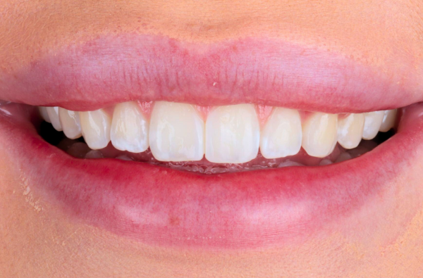 After -Halo Dental