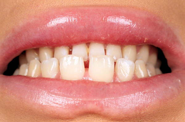 Before - Halo Dental