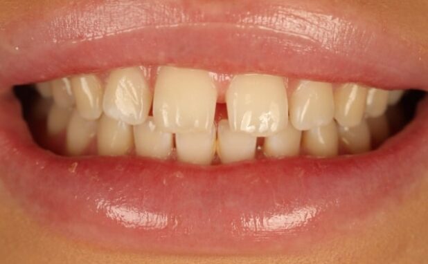 Before - Halo Dental