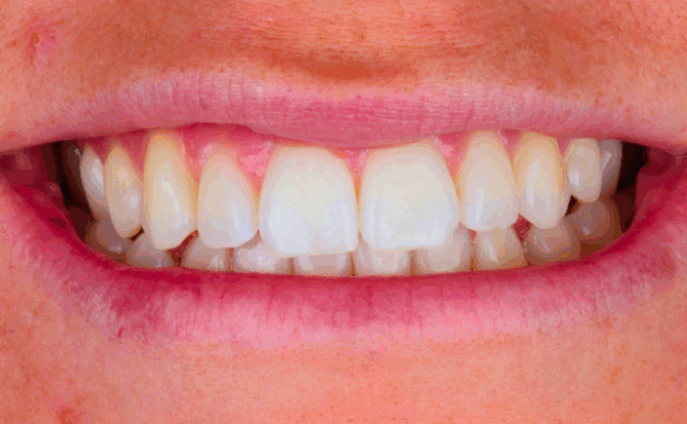 After -Halo Dental