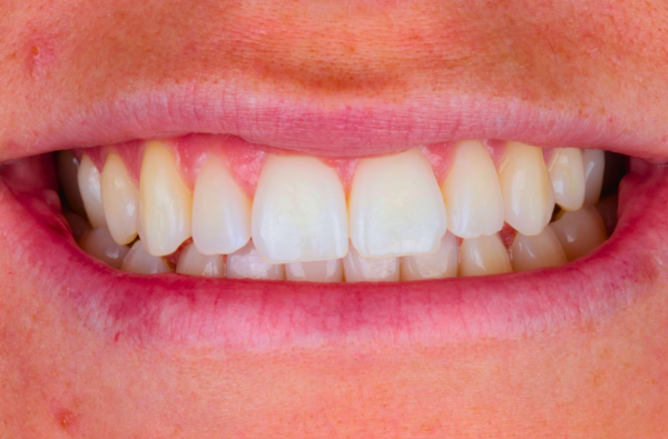 After -Halo Dental