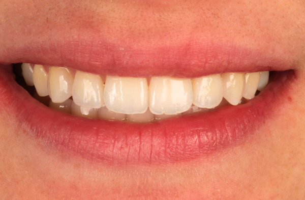 After -Halo Dental