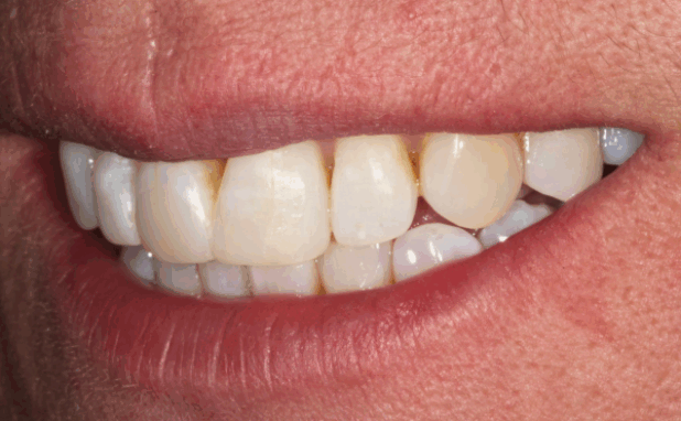 After -Halo Dental