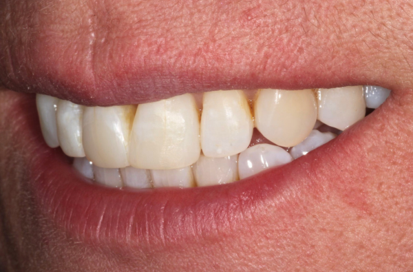 After -Halo Dental
