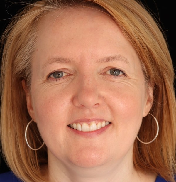 After Face -Halo Dental