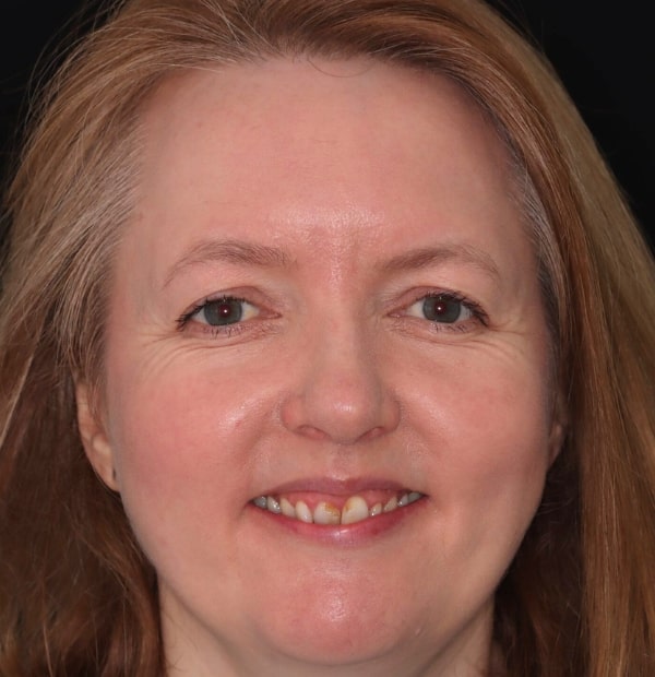 Before Face- Halo Dental