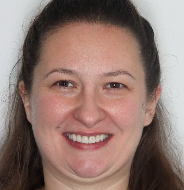 After Face -Halo Dental