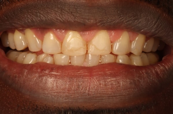 Before - Halo Dental