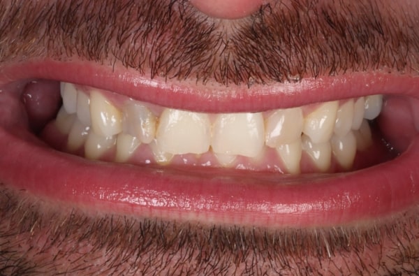 Before - Halo Dental