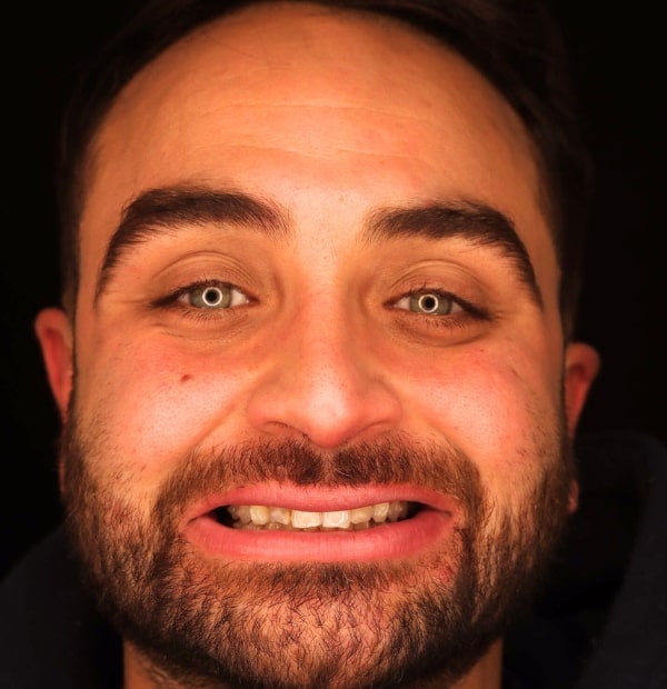 Before Face- Halo Dental