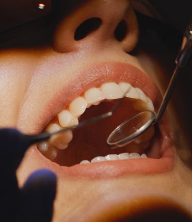 Treatment -  Halo Dental